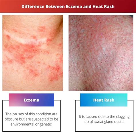 Symptoms of contact dermatitis include itching, swelling, and redness in the skin. . Cmpa rash vs eczema